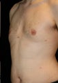 Male Breast Reduction