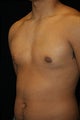 Male Breast Reduction