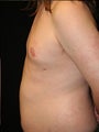 Male Breast Reduction