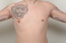 Gynecomastia with Vaser Liposuction