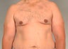 gynecomastia