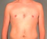 gynecomastia