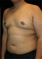 Male Breast Reduction