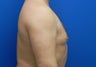 Male Gynecomastia Reduction