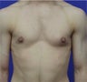 Male Breast Reduction
