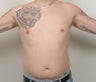 Gynecomastia