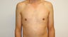 Gynecomastia 