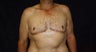 Gynecomastia 