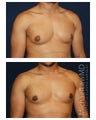 Gynecomastia