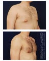 Gynecomastia