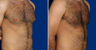 Male Breast Reduction