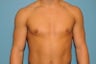 Gynecomastia