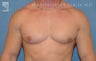 Gynecomastia (Male Breast Reduction)