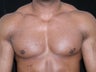 Male Breast Reduction