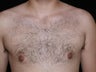 Male Breast Reduction