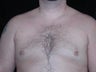 Male Breast Reduction
