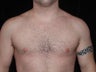 Male Breast Reduction