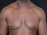 Male Breast Reduction