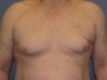 Gynecomastia, Male Breast Reduction