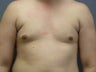 male breast reduction, gynecomastia