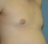 Gynecomastia