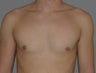 Male Breast Reduction