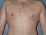 Gynecomastia, Male Breast Reduction