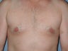 Gynecomastia, Male Breast Reduction
