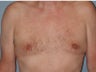 Gynecomastia, Male Breast Reduction