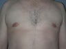 Gynecomastia, Male Breast Reduction
