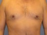 Gynecomastia, Male Breast Reduction