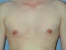 Gynecomastia, Male Breast Reduction
