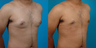 Male Breast Reduction