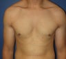 Male Breast Reduction