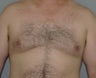 Gynecomastia