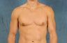 Male Breast Reduction