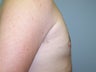 Male Breast Reduction