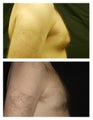 Gynecomastia
