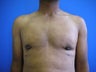 Male Breast Reduction