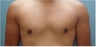 Gynecomastia