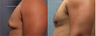 Gynecomastia (Male Breast Reduction)