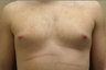 Male Breast Reduction