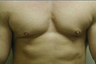 Male Breast Reduction