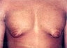 Male Breast Reduction