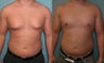 Male Breast Reduction