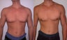 Male Breast Reduction