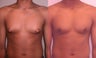 Male Breast Reduction