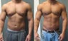 Male Breast Reduction