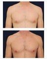 Gynecomastia