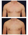 Gynecomastia